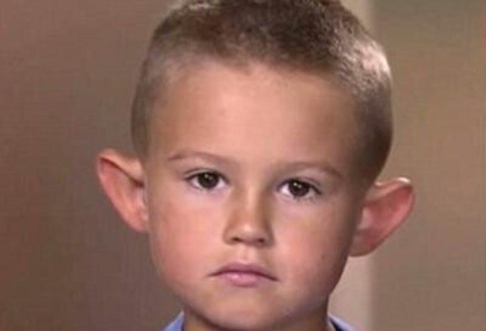 Salute: Addio orecchie a sventola, arriva la clip anti-chirurgia