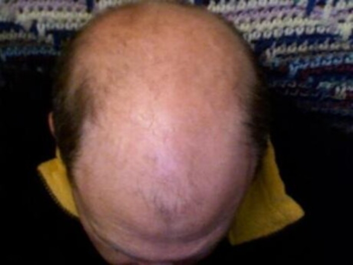 Insulina arma anti-calvizie, rigenera i follicoli