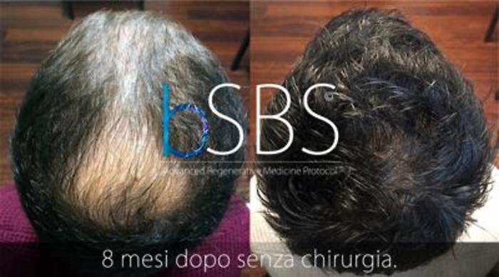 Salute: insulina arma anti-calvizie, rigenera i follicoli