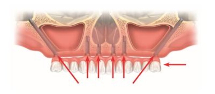L&rsquo;implantologia dentale per risolvere l&rsquo;edentulia