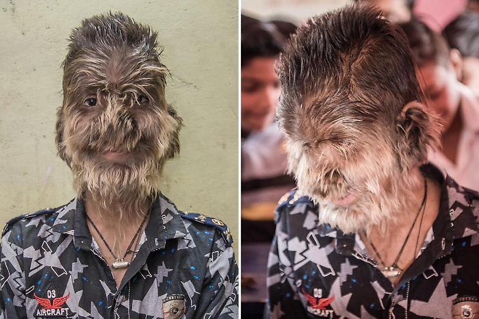 Spagna, sindrome del "lupo mannaro" per 17 bambini