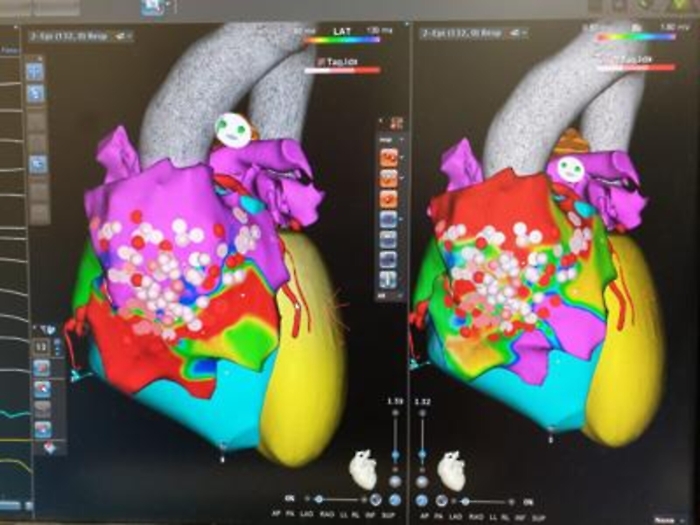 Medicina: Clinica Mediterranea Napoli, nuova tecnica per sindrome di Brugada