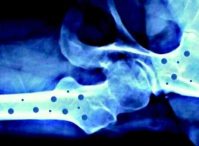 Farmaci: 4 mln italiani con osteoporosi, nuovo algoritmo per cure appropriate