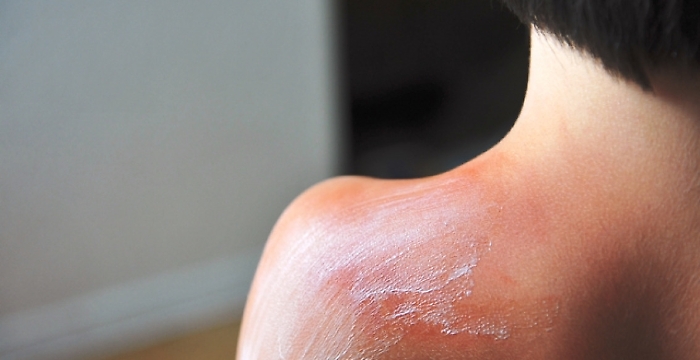 Ustione da acqua calda