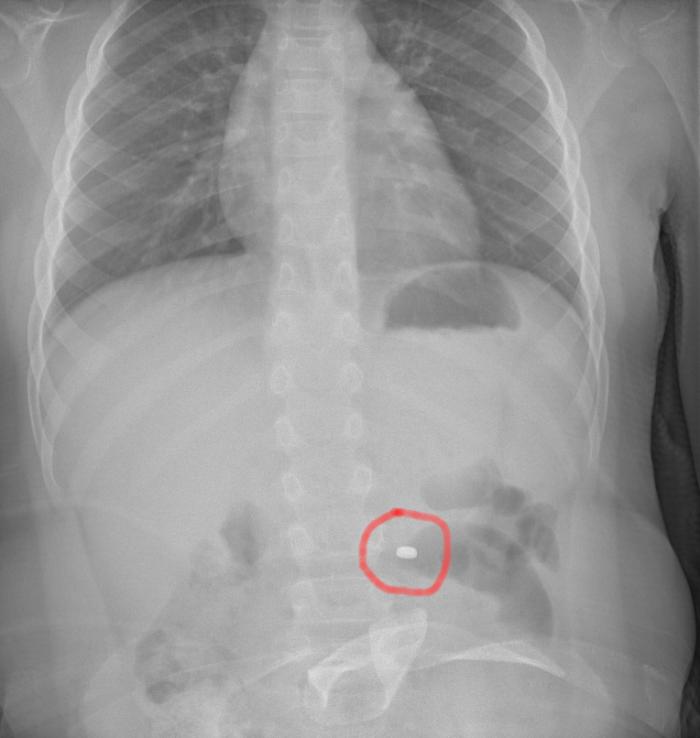 Bimbo operato al Cannizzaro dopo aver ingerito una pila a bottone