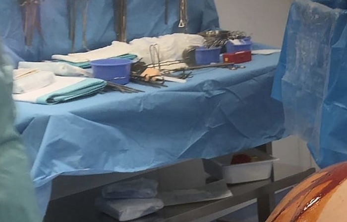 Enorme tumore ovarico asportato a Taormina