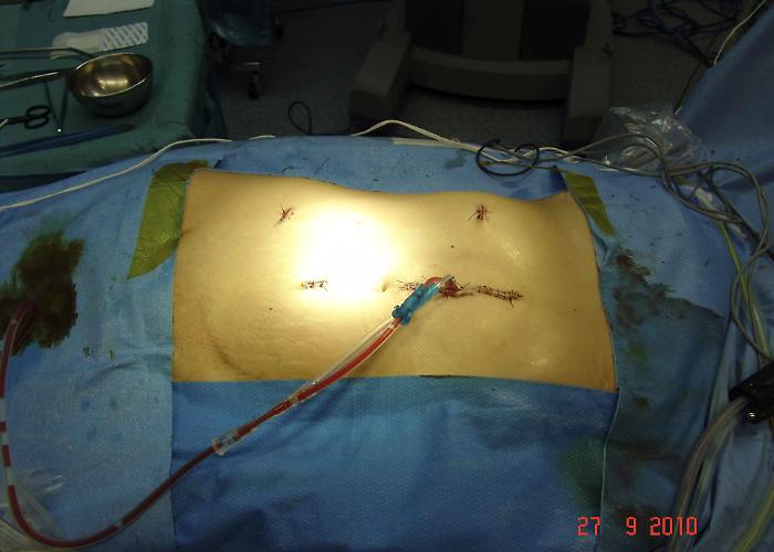 Pancreas, il giorno in cui il tumore &egrave; scomparso: dentro la strategia spagnola che ha &ldquo;spento&rdquo; il PDAC nei topi