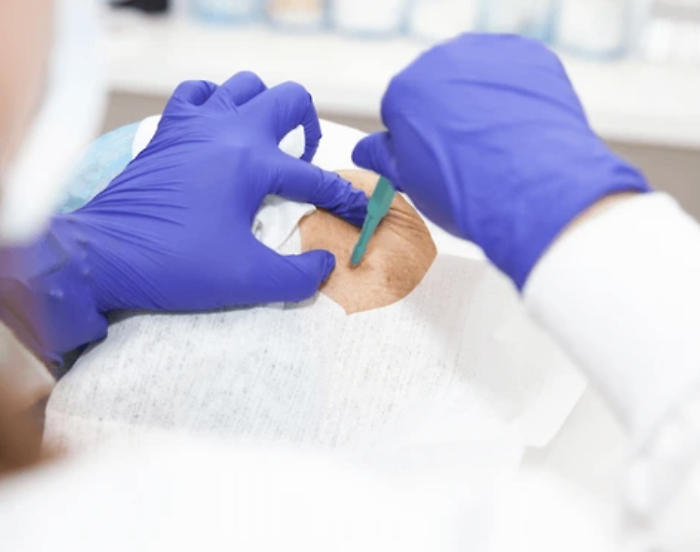 "Biopsia entro dieci giorni" e l'Asp di Ragusa gliel'assegna in sei mesi: Articolo 32 non ci sta e protesta