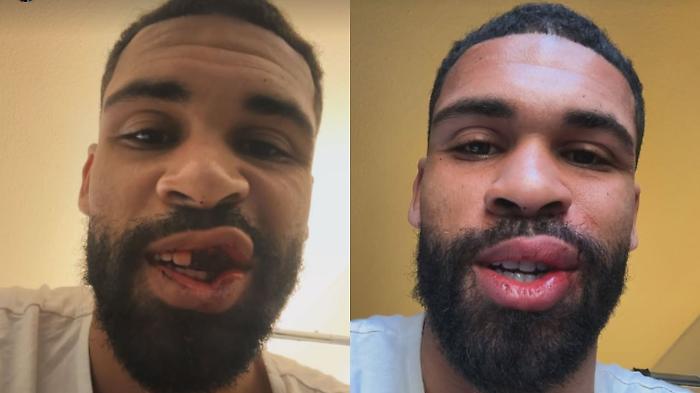 Shock Loftus-Cheek: il calciatore del Milan posta la foto dopo il fallo subito contro il Parma