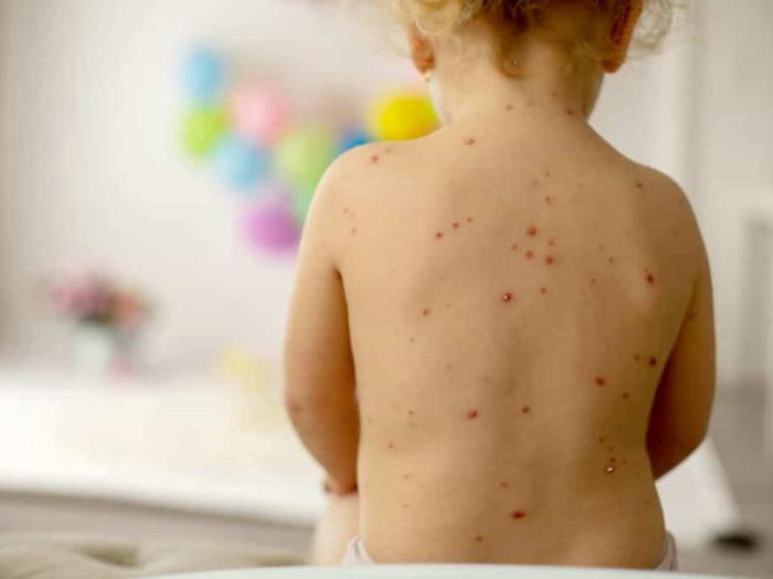 Morbillo, la Sicilia &egrave; la regione con meno vaccinati di tutt&rsquo;Italia: solo il 67,8% e l'immunit&agrave; di gregge diventa un'utopia